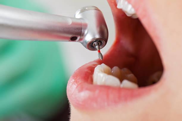 Best Emergency Treatment for Toothache in Syracuse, NY